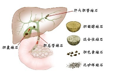 胆管结石